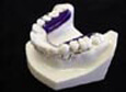 Inman Aligner Retraction Appliance